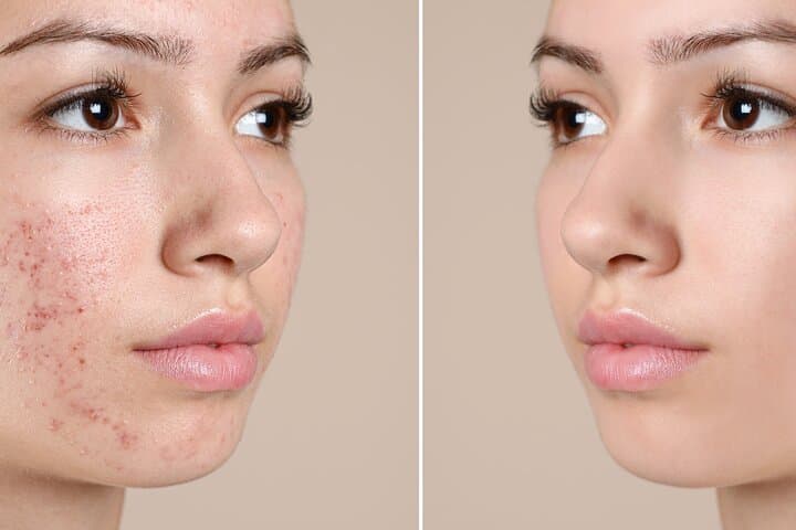 Newport Beach Couples Skin Glo: Microderm, LED Therapy and Wine photo 6